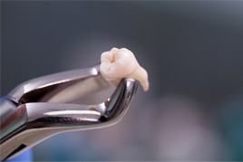 Dental forceps holding an extracted tooth