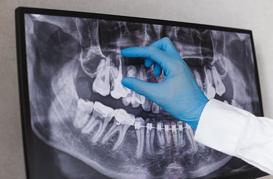 Endodontist pointing to a tooth root on an X-ray
