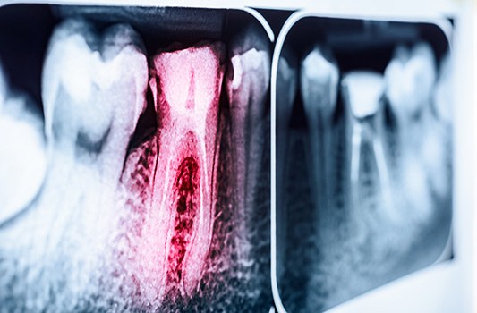 Factors that can affect the cost of a root canal retreatment include the severity of the tooth infection