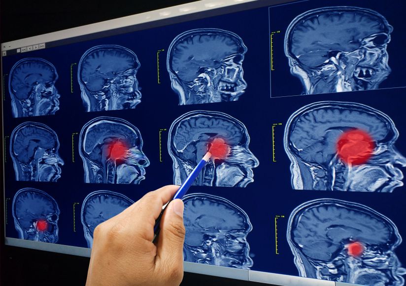 MRI Images of a brain with an abscess